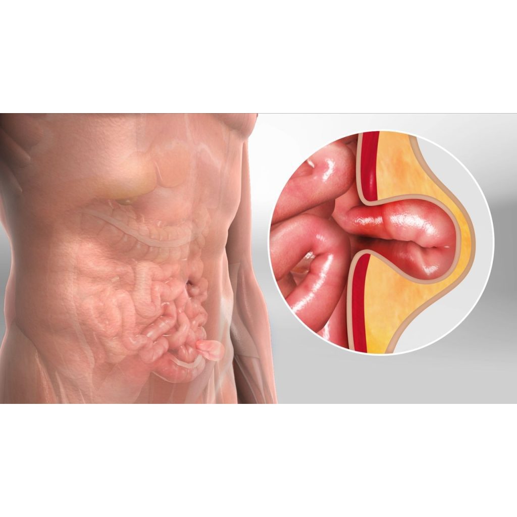 أعراض الفتق الإربي التي تستدعي زيارة العيادة
