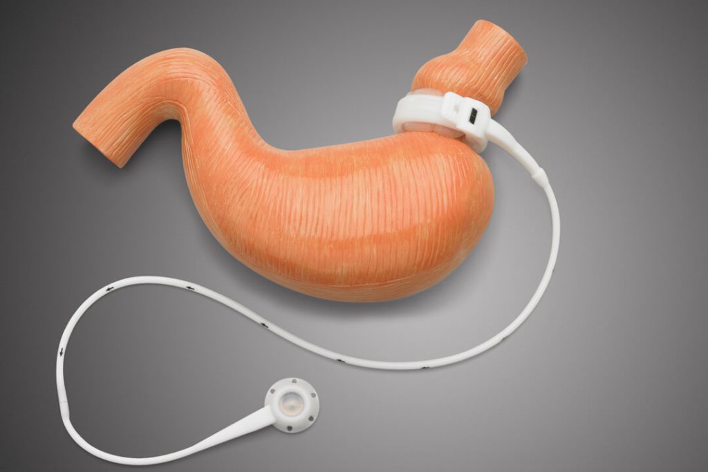 الاستعداد لجراحة ربط المعدة في عيادة الدكتور رامي