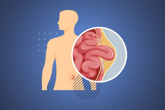 جراحة الفتق بالمنظار