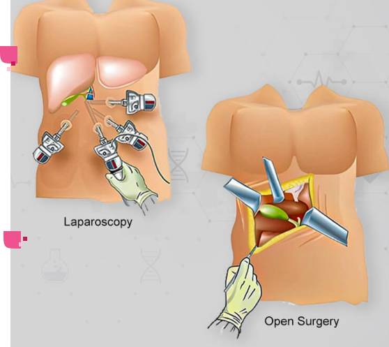 مقارنة بين جراحة المناظير والجراحات التقليدية