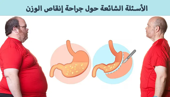 الأسئلة الشائعة حول جراحة إنقاص الوزن