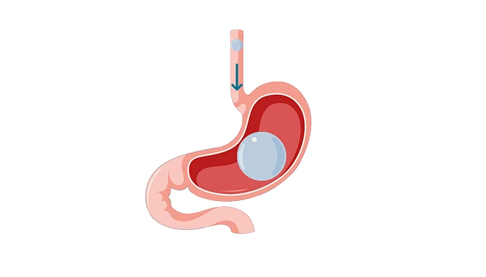 بالون المعدة: الحل الفعال لفقدان الوزن بدون جراحة!