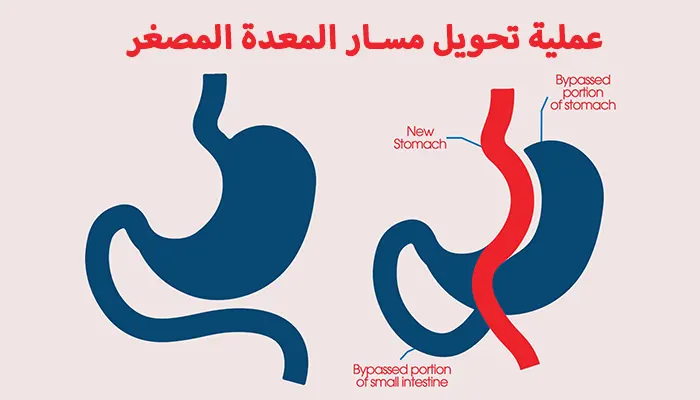 عملية تحويل مسار المعدة المصغر الحل الأمثل لعلاج السمنة