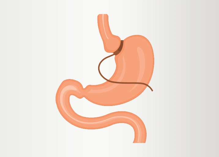 عملية حلقة المعدة الفوائد والتكلفة وأهم التفاصيل