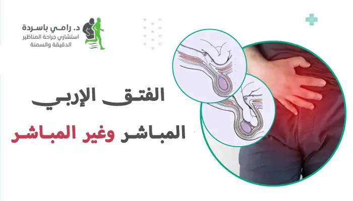 الفتق الإربي المباشر وغير المباشر | دليل شامل