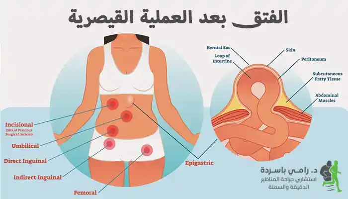 الفتق بعد العملية القيصرية