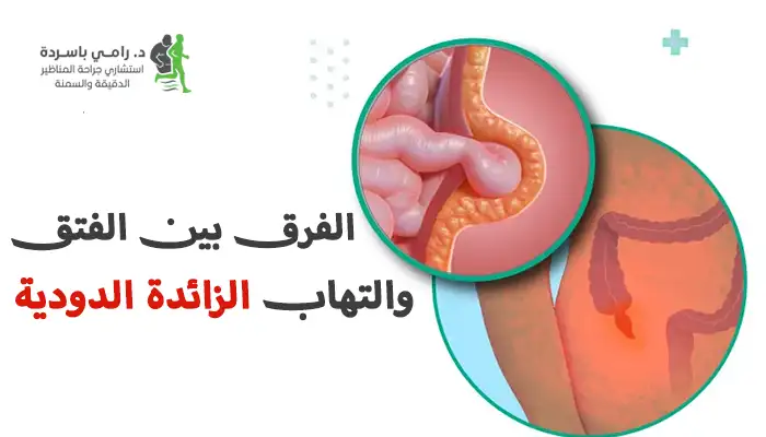 الفرق بين الفتق والتهاب الزائدة الدودية