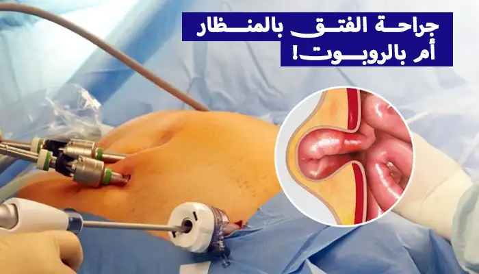 جراحة الفتق بالمنظار أم بالروبوت: أيهما الأنسب لك؟