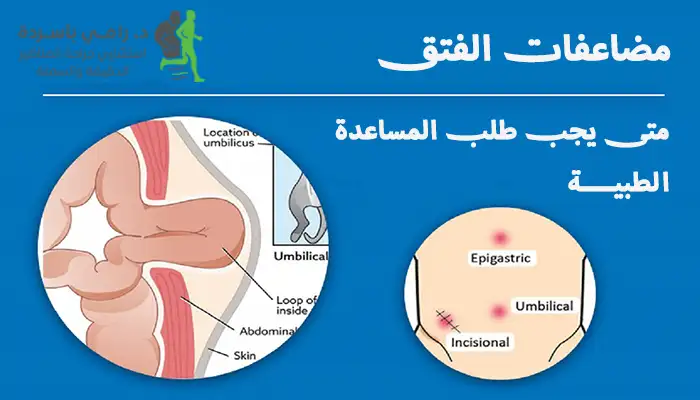 مضاعفات الفتق: متى يجب طلب المساعدة الطبية