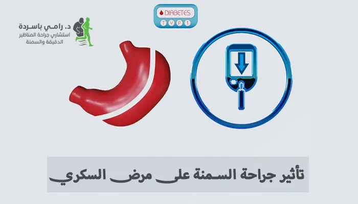 تأثير جراحة السمنة على مرض السكري