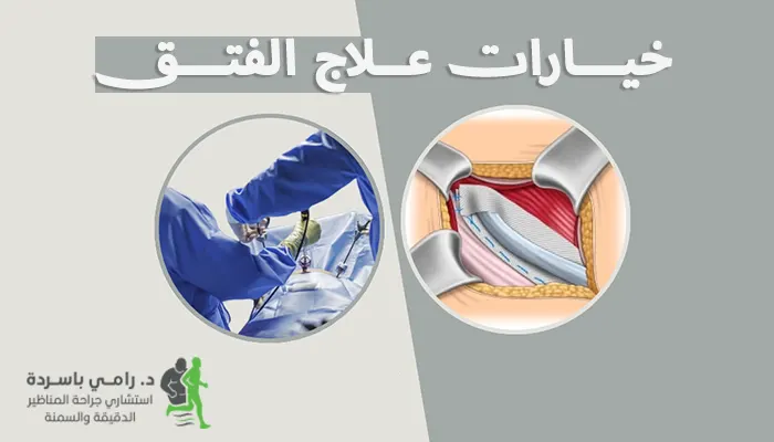 خيارات علاج الفتق بالجراحة والمنظار