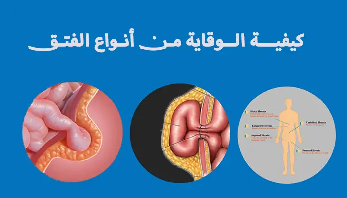 كيفية الوقاية من مشكلة جميع أنواع الفتق