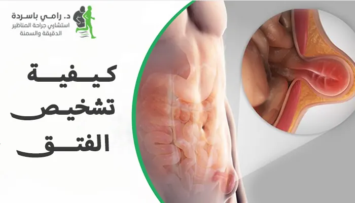 كيفية تشخيص الفتق: دليل شامل للكشف المبكر