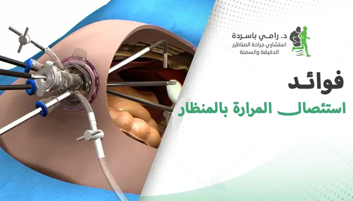 فوائد استئصال المرارة بالمنظار