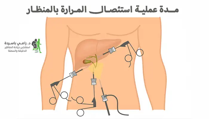 مدة عملية استئصال المرارة بالمنظار