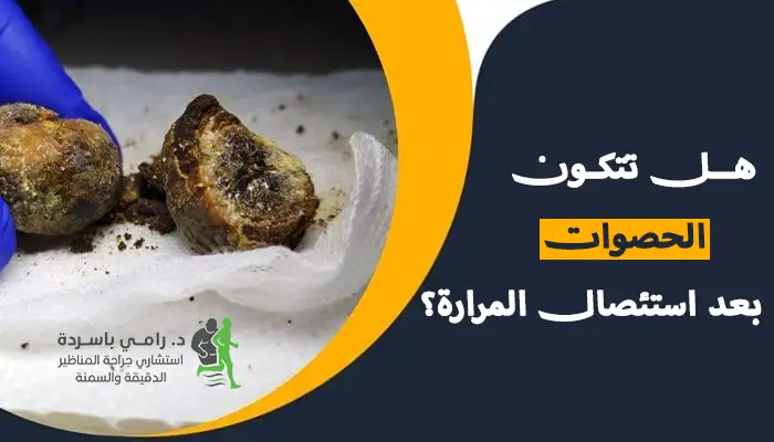 هل تتكون الحصوات بعد استئصال المرارة؟