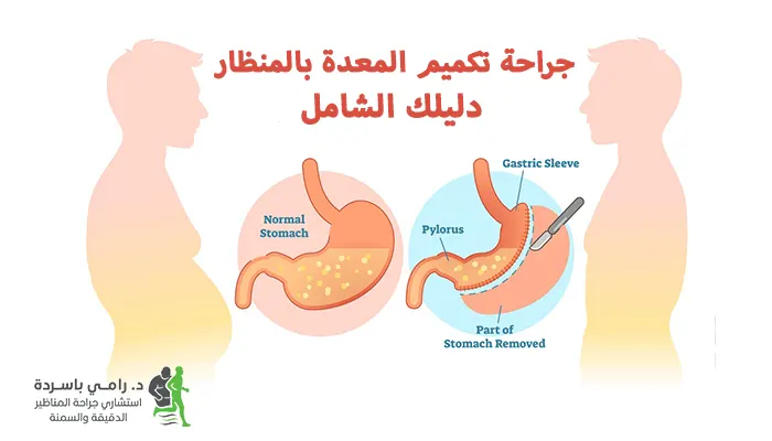 جراحة تكميم المعدة بالمنظار: دليلك الشامل