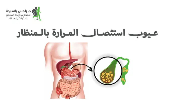 عيوب استئصال المرارة بالمنظار