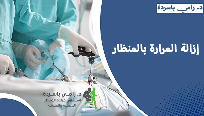 إزالة المرارة بالمنظار