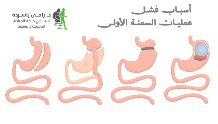 أسباب فشل عمليات السمنة الأولى