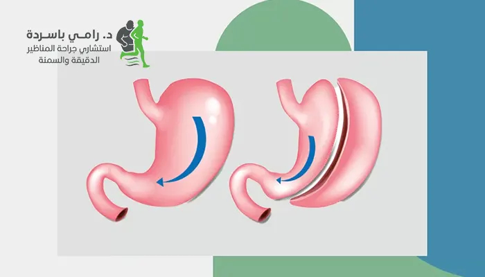 خطوات عملية تكميم المعدة بالتفصيل