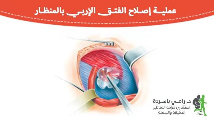 عملية إصلاح الفتق الإربي بالمنظار