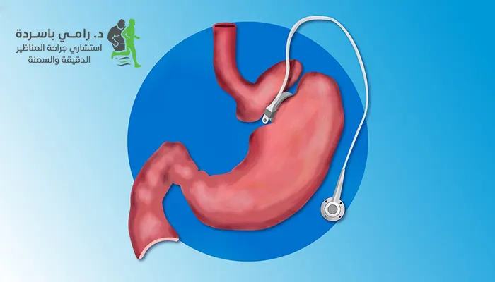 ما هي حلقة المعدة وكيف تعمل؟