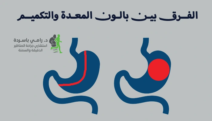 الفرق بين بالون المعدة والتكميم