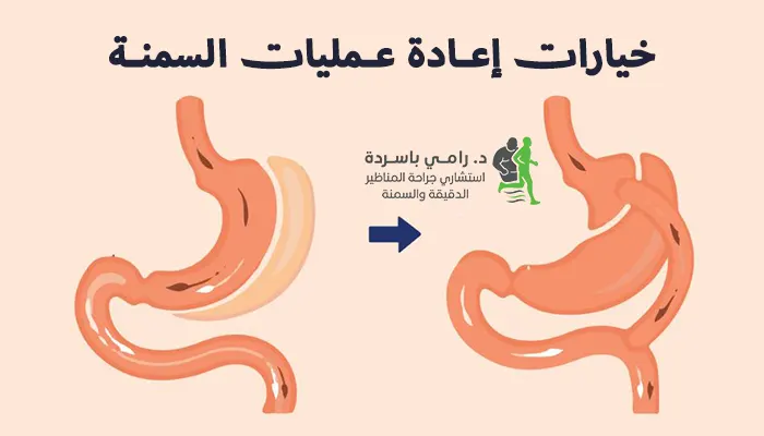 خيارات إعادة عمليات السمنة: تكميم أم تحويل مسار؟