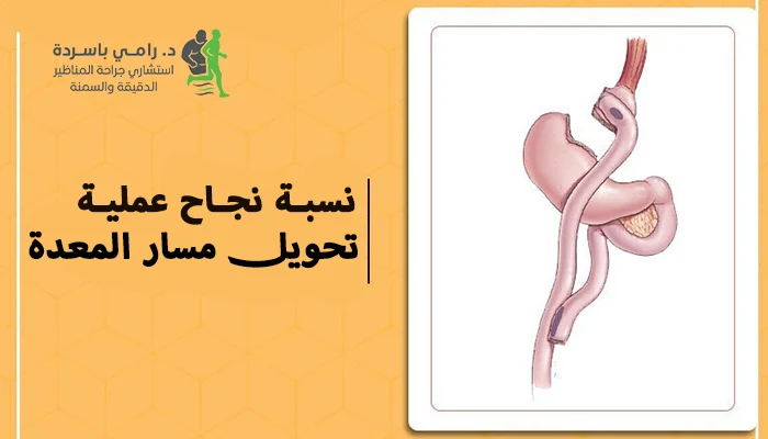 نسبة نجاح عملية تحويل مسار المعدة