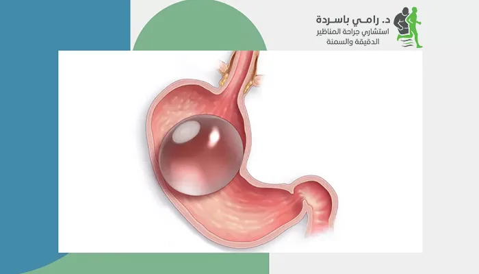 بالون المعدة: حل غير جراحي لإنقاص الوزن