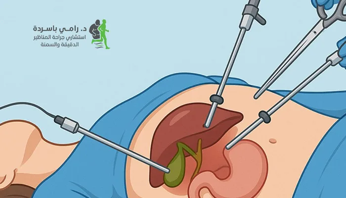 خطوات عملية استئصال المرارة بالمنظار