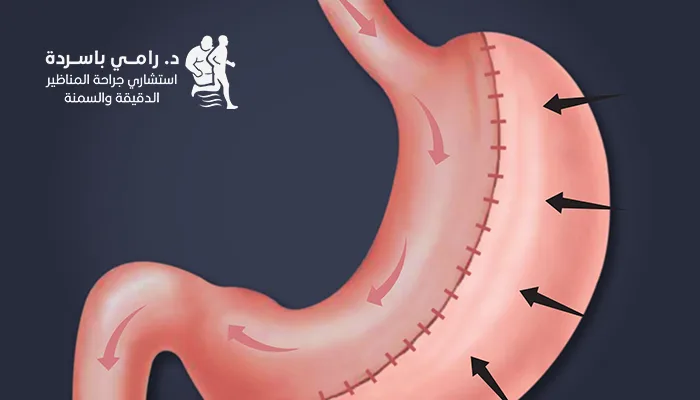 مضاعفات تكميم المعدة الشائعة وطرق الوقاية