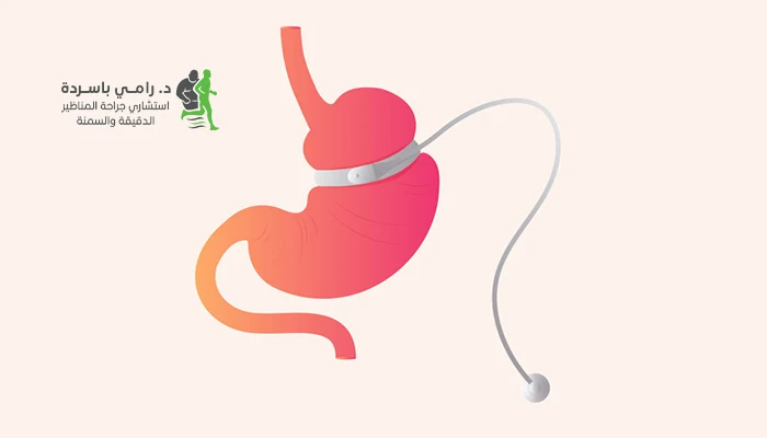 متى يجب إزالة حلقة المعدة؟