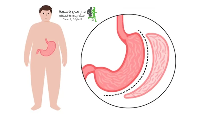 هل تكميم المعدة آمن؟ المضاعفات ونصائح الوقاية
