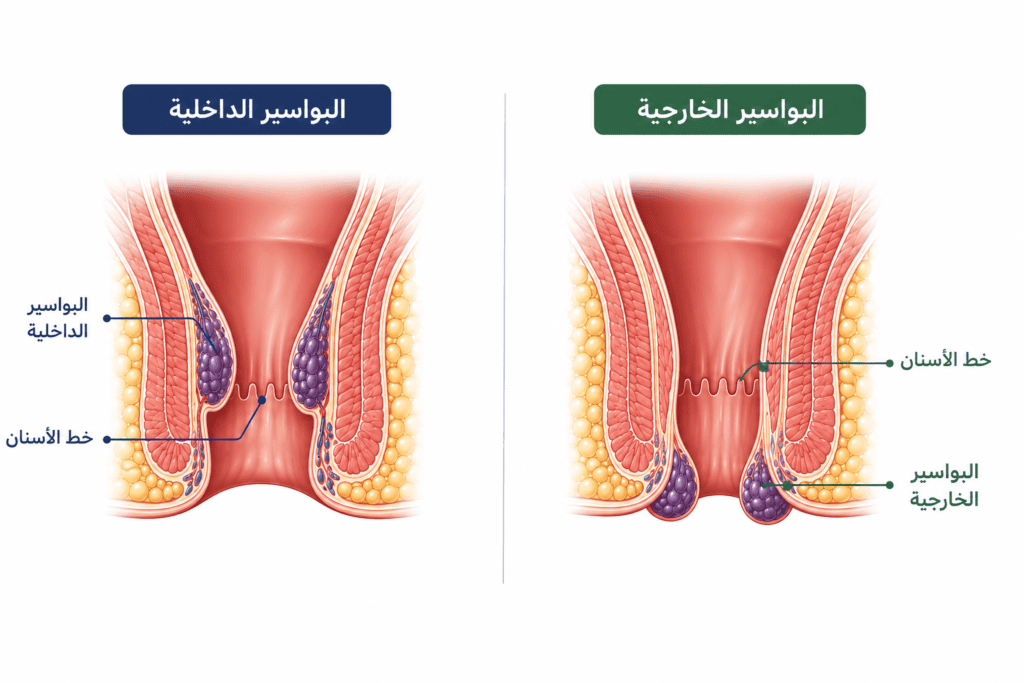 رسم يوضح البواسير الداخلية والبواسير الخارجية وموقعهما داخل القناة الشرجية وحول فتحة الشرج.